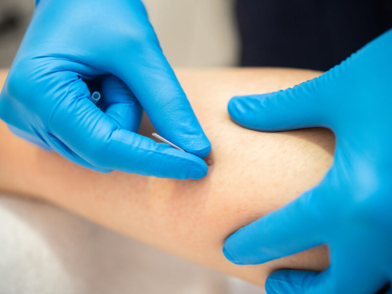 dry needling in cumbria